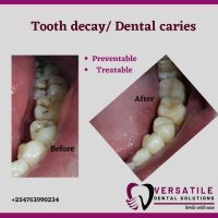 Tooth Coloured Fillings – Versatile Dental Solutions